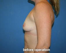plastic-surgery-breast-augmentation